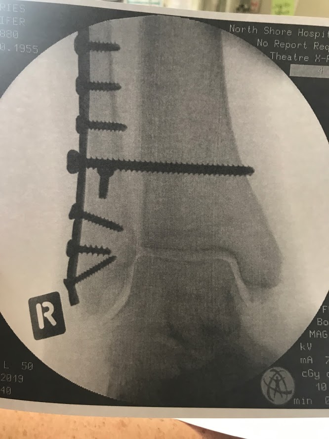 ANkleInjury