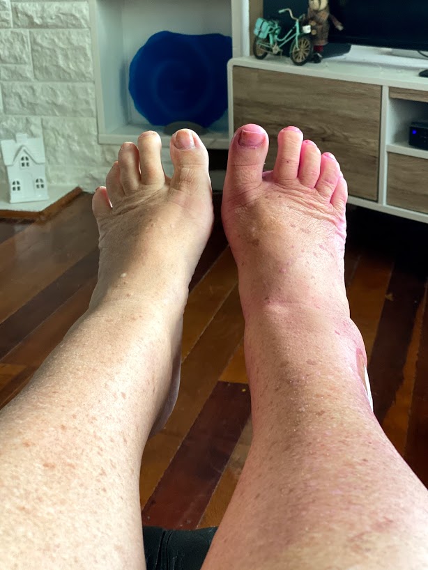 Anklerepair
